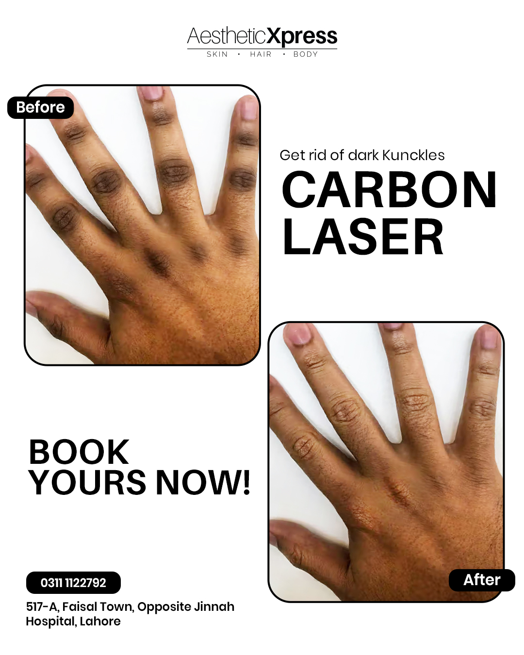 Aesthetic Xpress Facebook ad: Enjoy long-lasting smooth skin with our advanced laser…