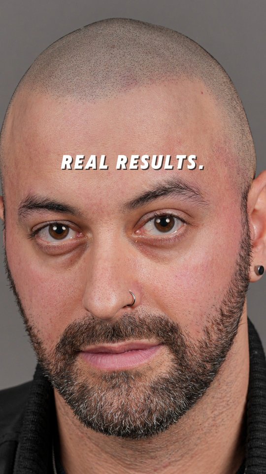 Enhanced Scalp Facebook ad: Real results. No filters.