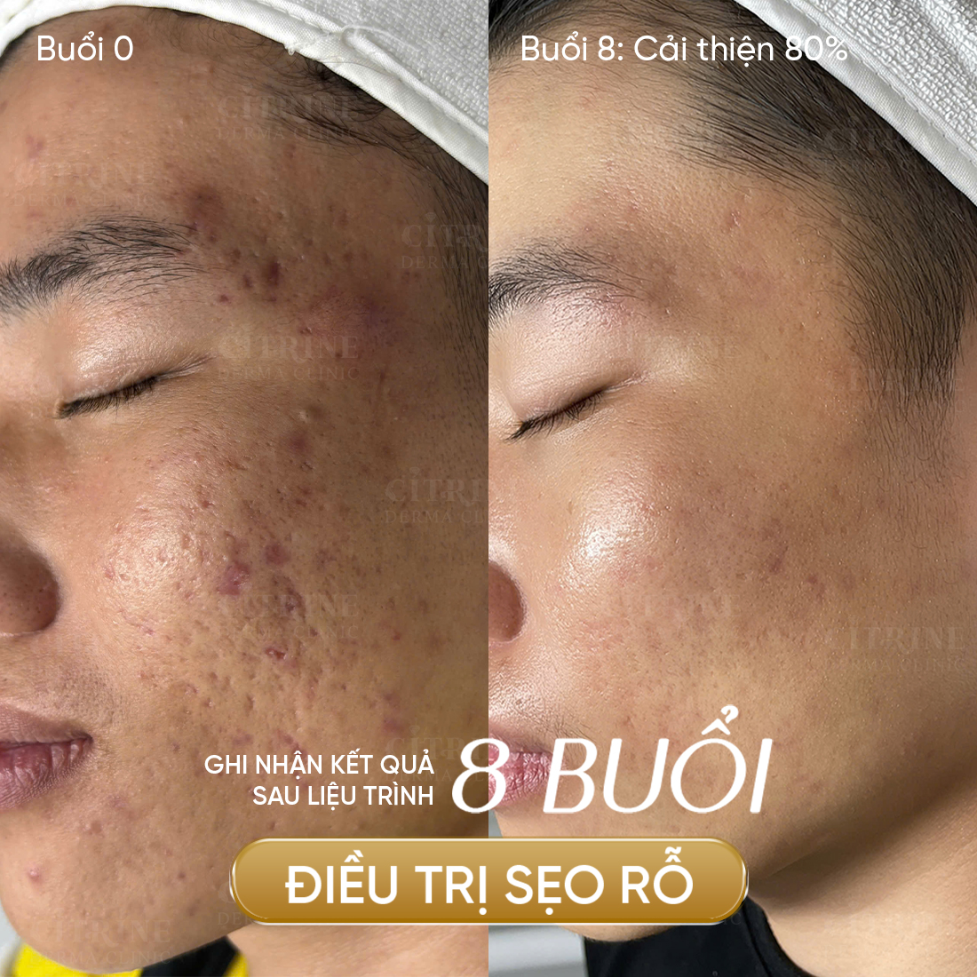 Bác Sĩ Châu Ngọc Tố Trinh - Citrine Derma Clinic Facebook ad: /𝐄𝐧𝐠𝐥𝐢𝐬𝐡 𝐛𝐞𝐥𝐨𝐰/ TRỊ SẸO RỖ, MUA 4 TẶNG…