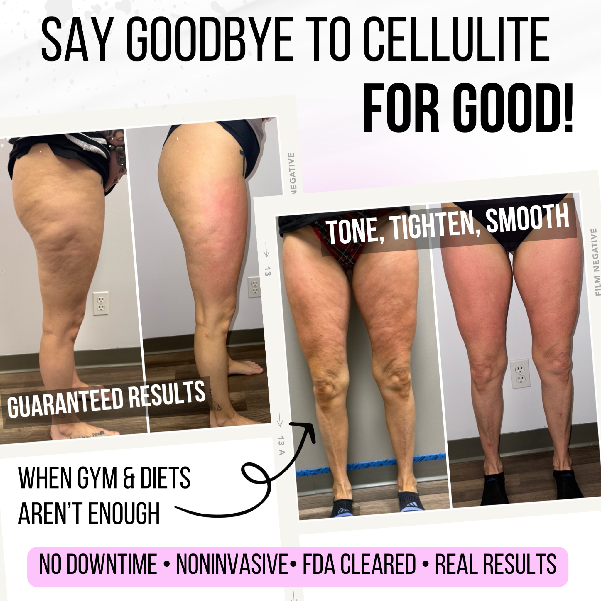 Elite Aesthetics & Medical Care, LLC Facebook ad: T-Shape Skin Tightening Special - $159 ONLY