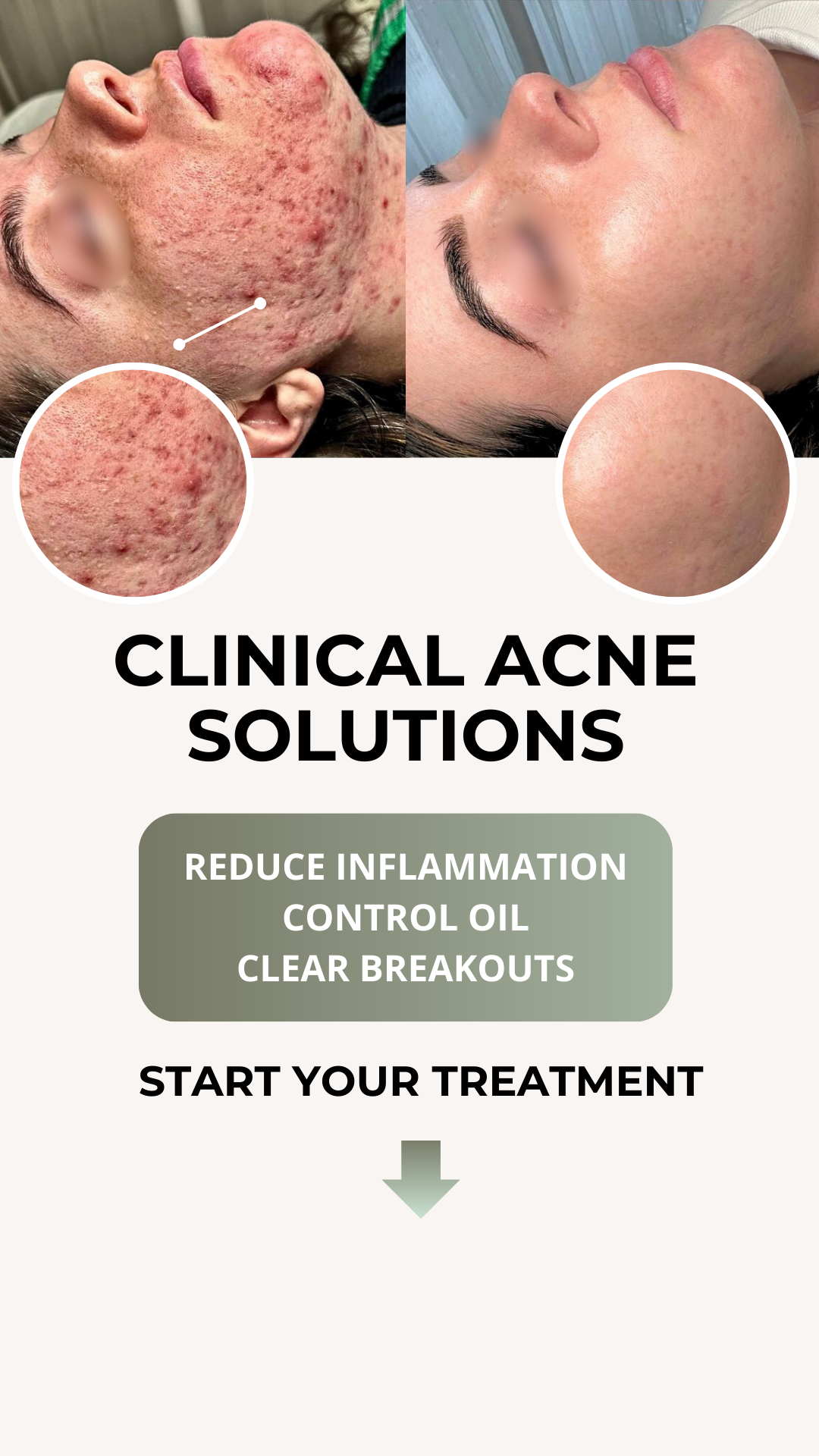 Acne Clinic NYC: Acne, Pigmentation, and Scars Treatment Facebook ad