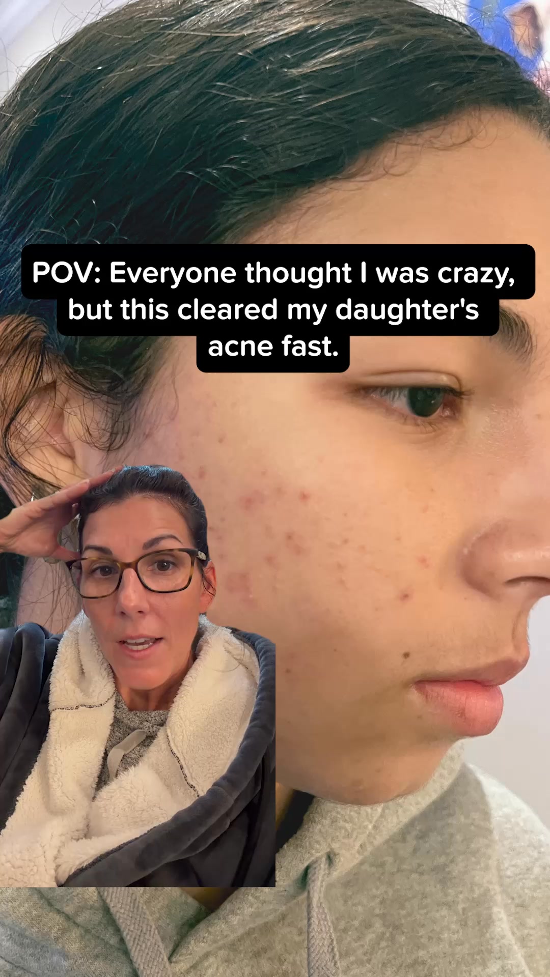 Meredith Masony Facebook ad: Stop Acne or Money Back