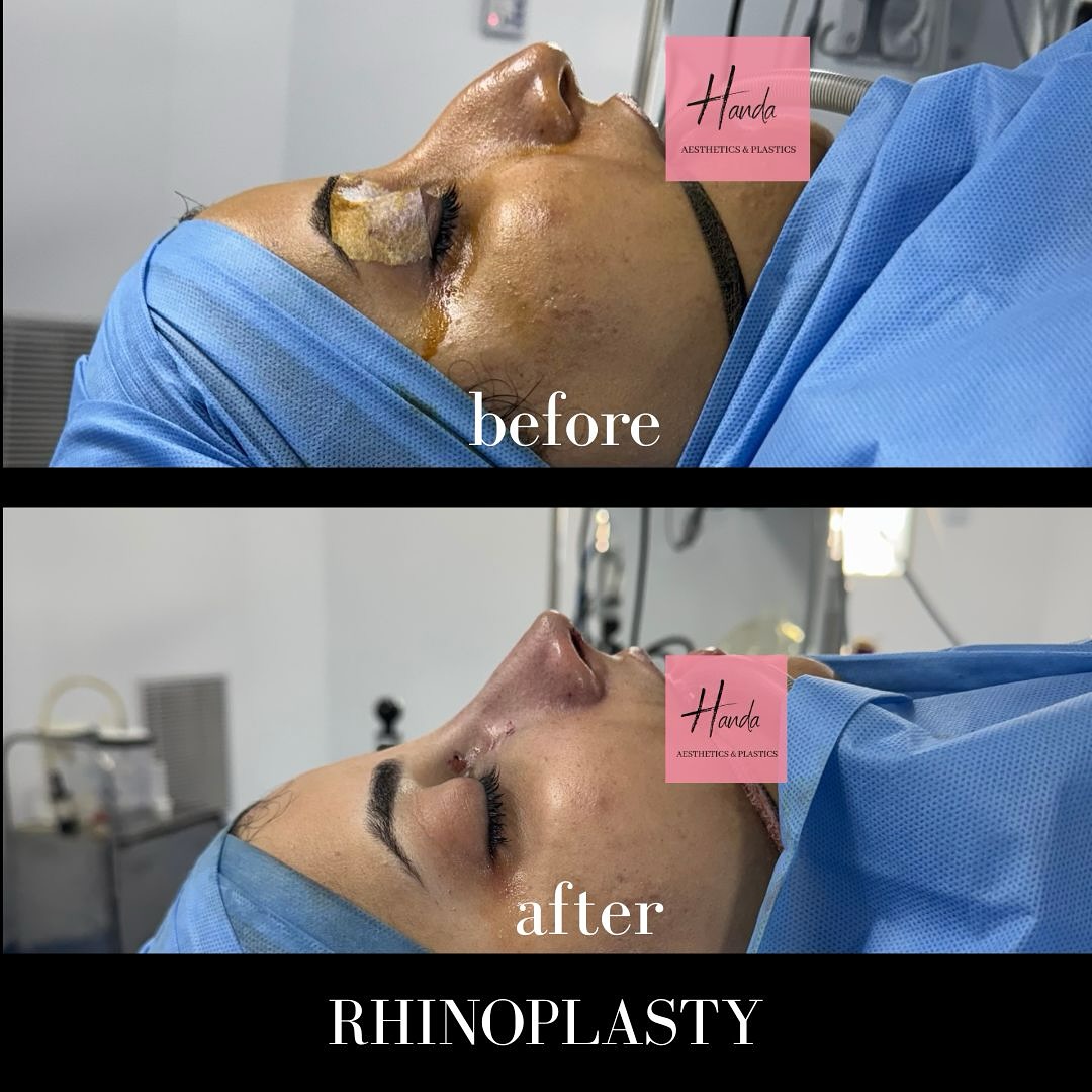Handa Aesthetics & Plastic Surgery Facebook ad: Barbie doll rhinoplasty, it’s a term often used…