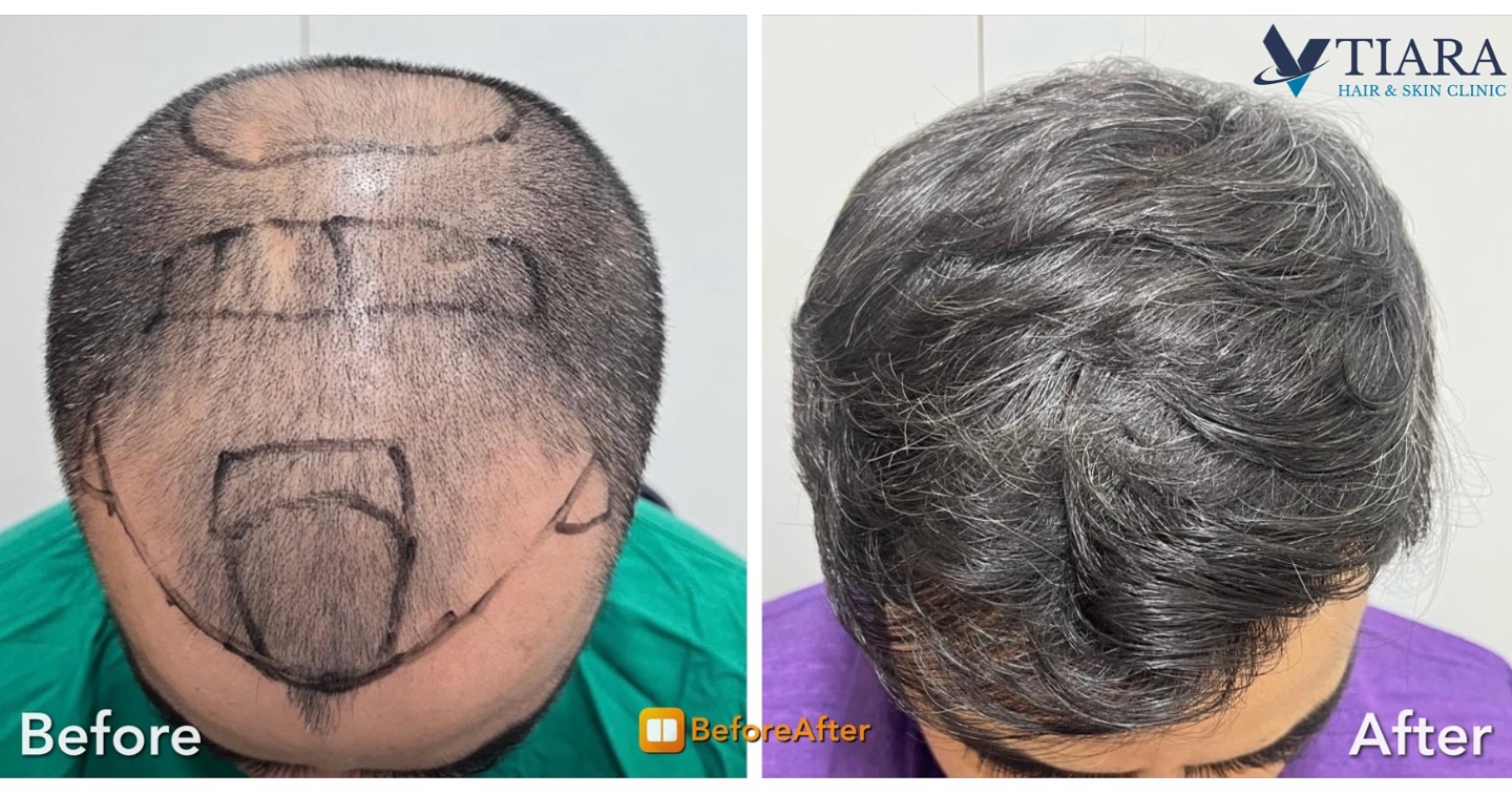 Vtiara Clinic Facebook ad: Jeevan’s Hair Transplant Success Story: A Life-Changing…