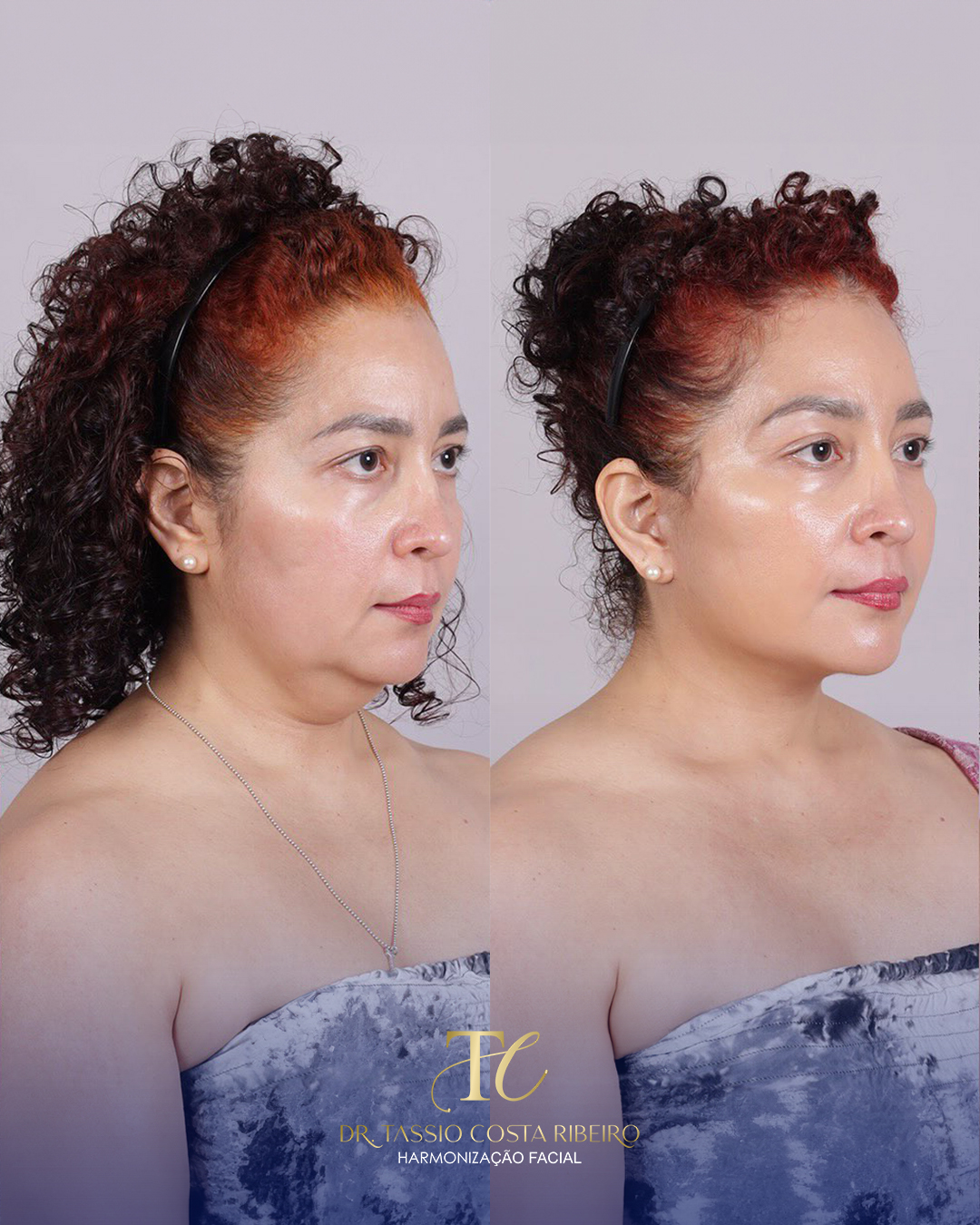 Dr. Tassio Costa Facebook ad: Lipo de Papada