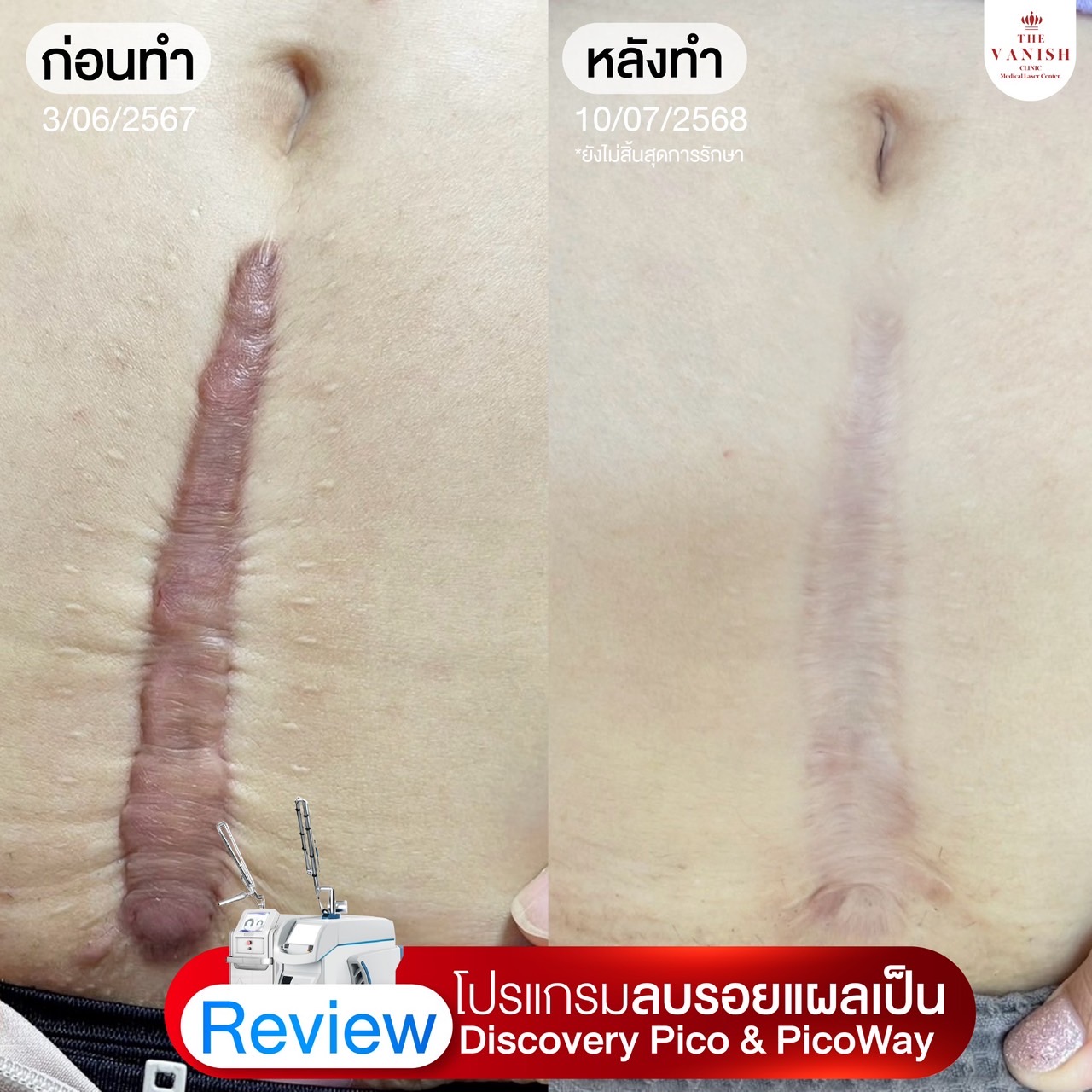 The Vanish Laser Center Facebook ad