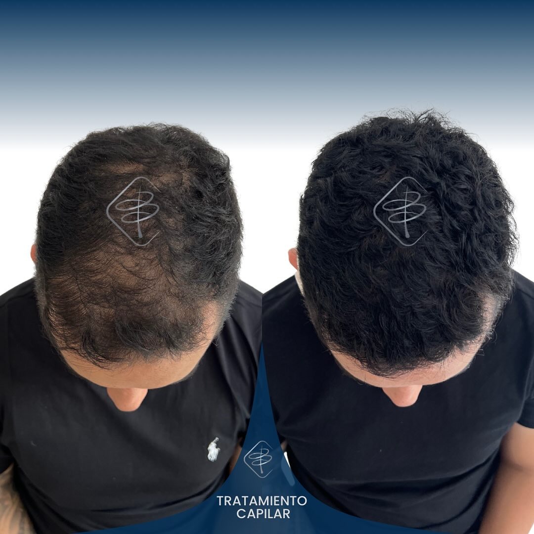Clinica_Biodermo Facebook ad: Recuperar tu cabello puede comenzar en solo 3…