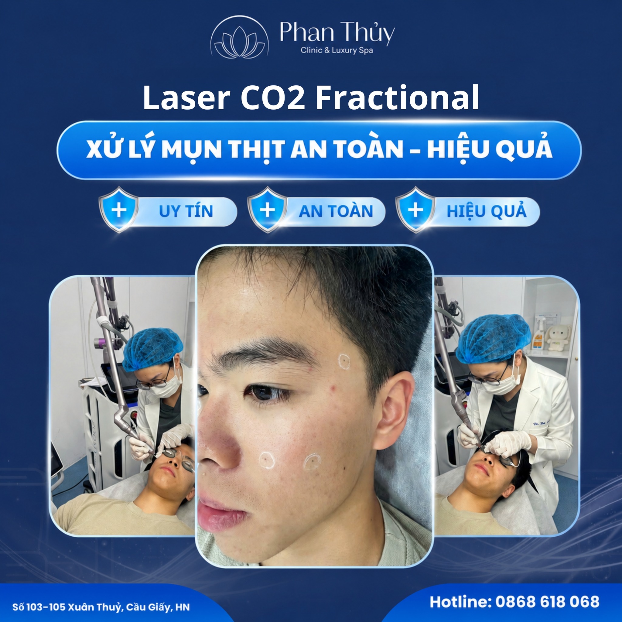 Phòng Khám Chuyên Khoa Da Liễu Phan Thuỷ Facebook ad: CẬP NHẬT CA THỰC TẾ: XỬ LÝ MỤN…
