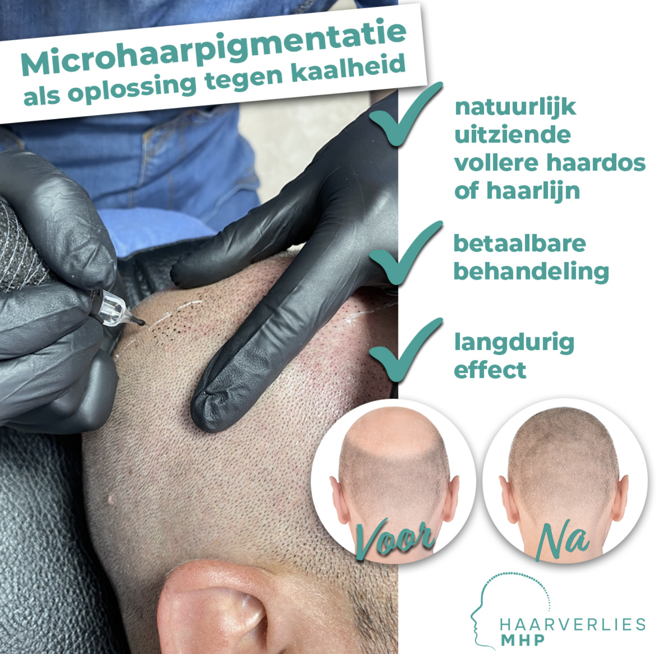 Haarverlies MHP Facebook ad: Op dit moment bieden we 15% korting op Micro Scalp…