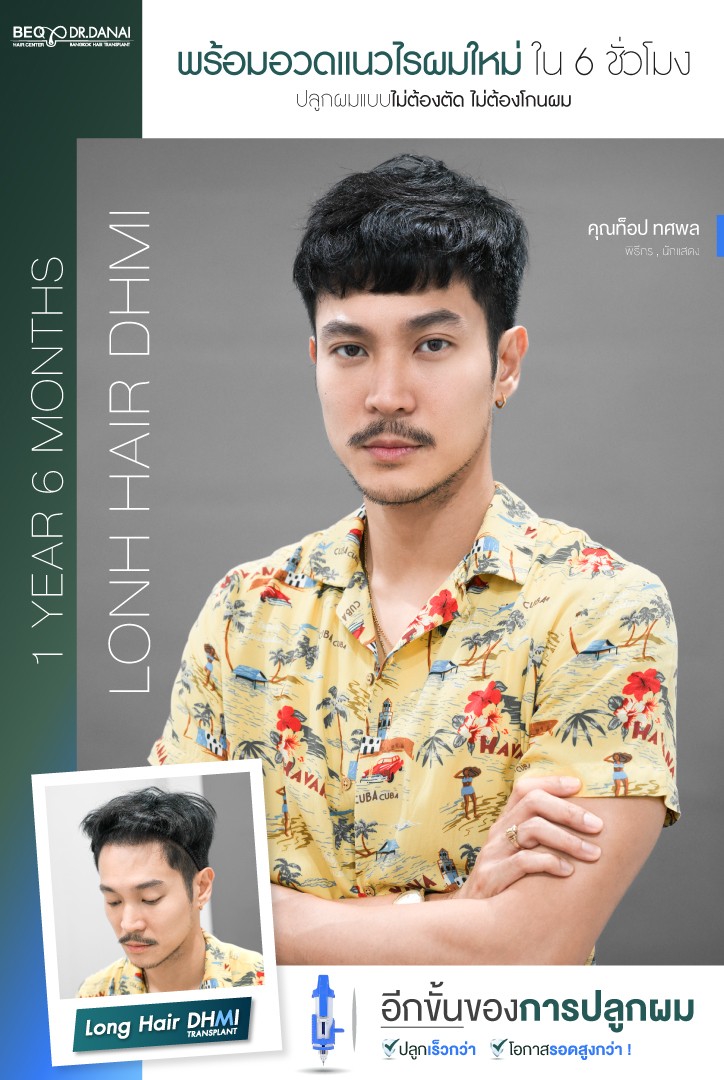 Dr. Danai Bangkok Hair Transplant ปลูกผมถาวร Facebook ad