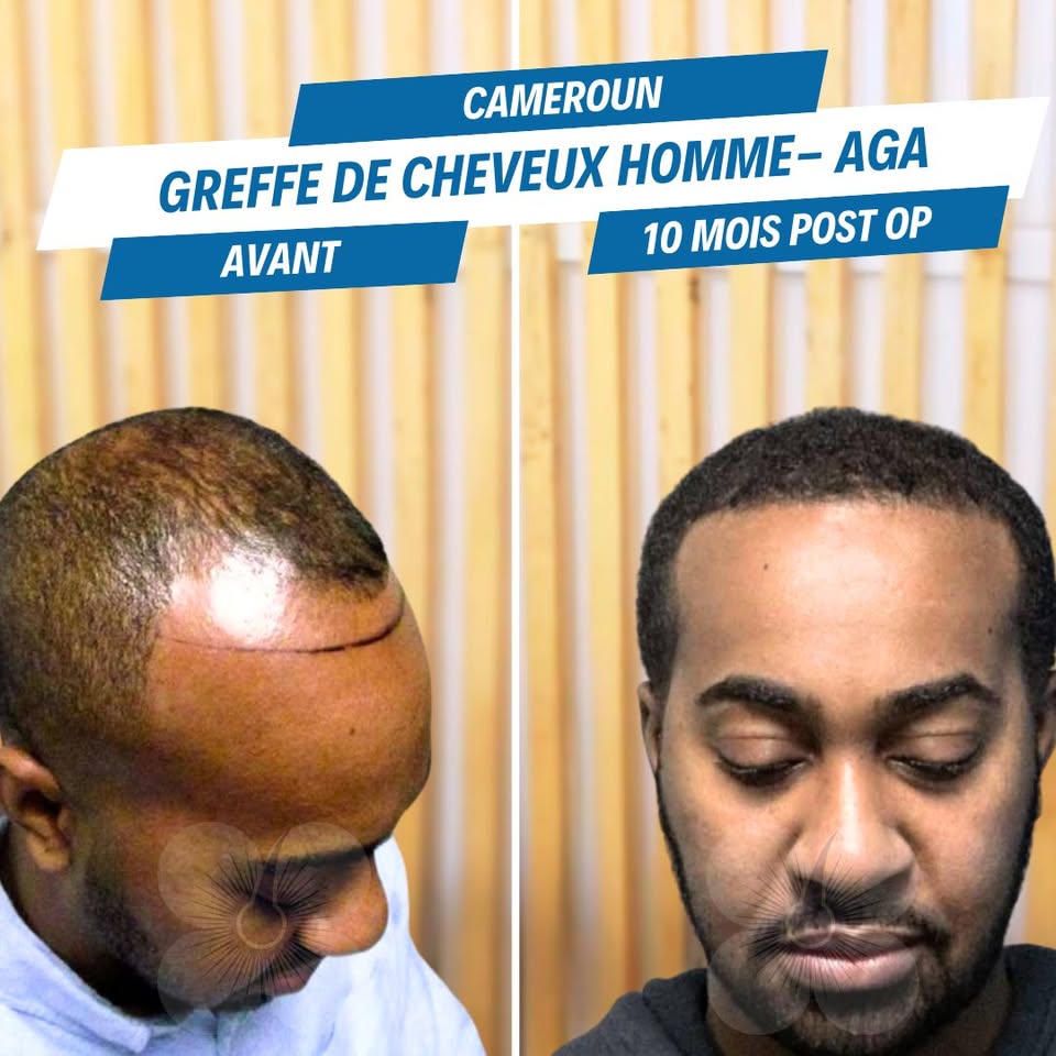 Hair Treatment Agency.Cameroon Facebook ad: Traitement de l’alopécie androgénétique (AGA) chez l’homme