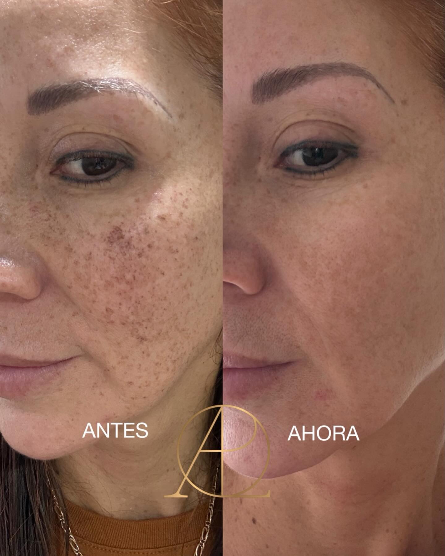 Dra. Paola Espinoza Cuadros Facebook ad: Rejuvenecé tu piel con Láser Nordlys