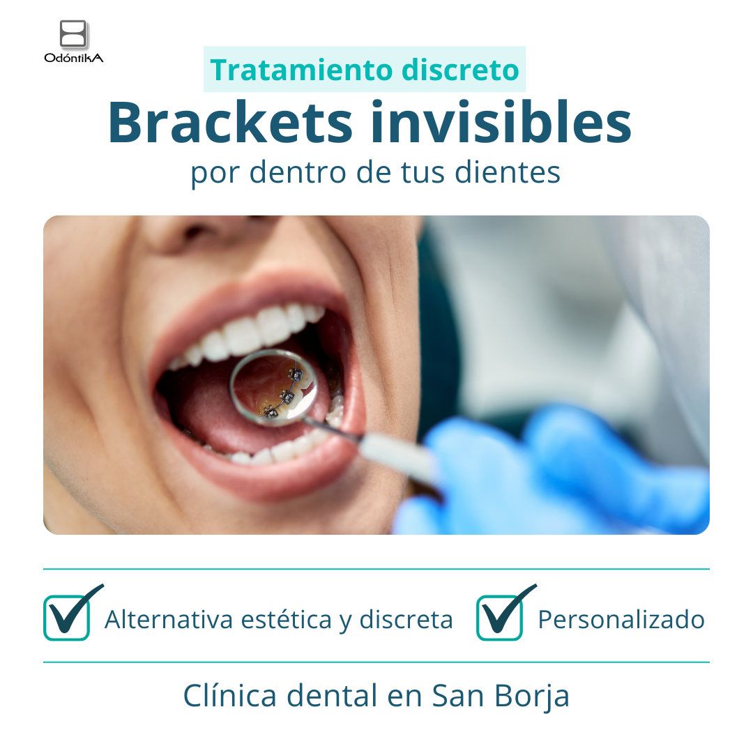 Centro Odontológico Odóntika Facebook ad: BRACKETS LINGUALES SAN BORJA