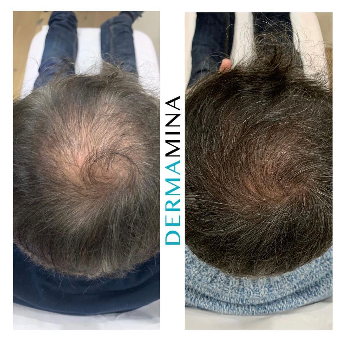 DermaMina Facebook ad: Thought your only option was a hair transplant?