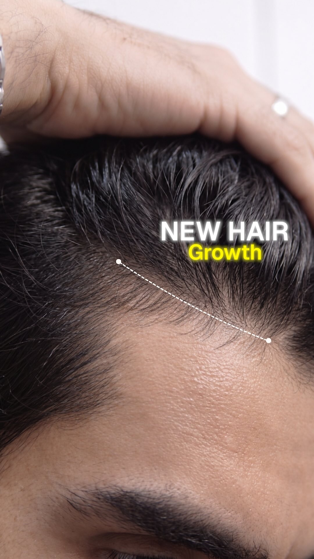 Arata Facebook ad: Hair fall in your 20s?