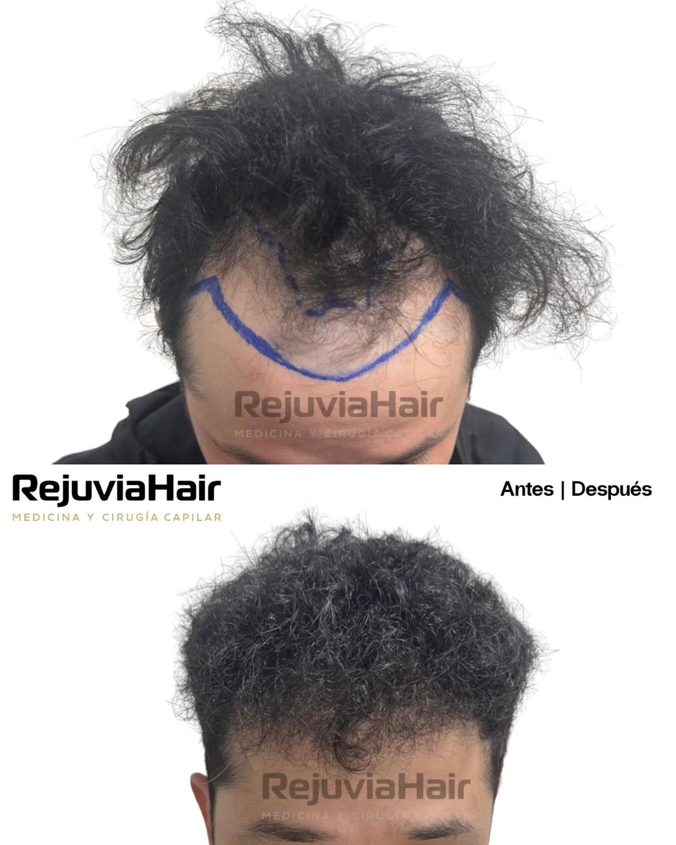 RejuviaHair Facebook ad: 8 meses post trasplante capilar.