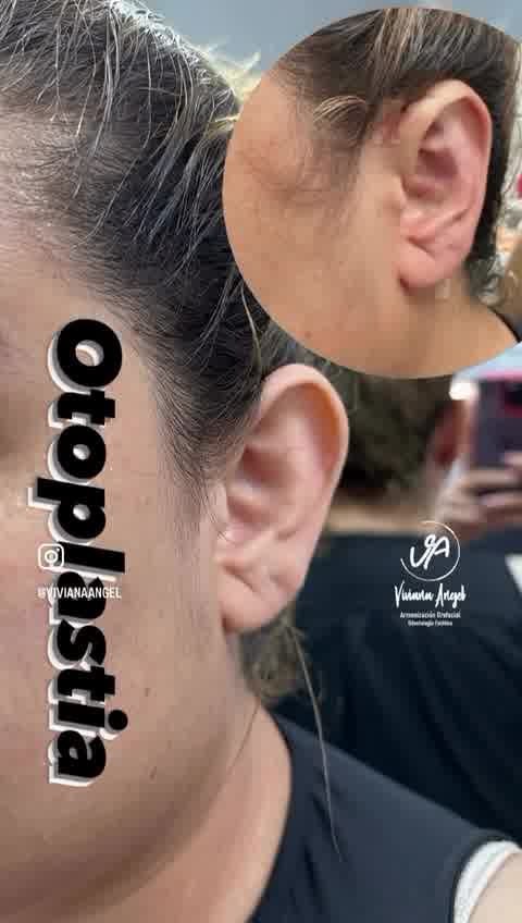 Armonizacion Facial Dra Viviana Angel Facebook ad: Escribenos