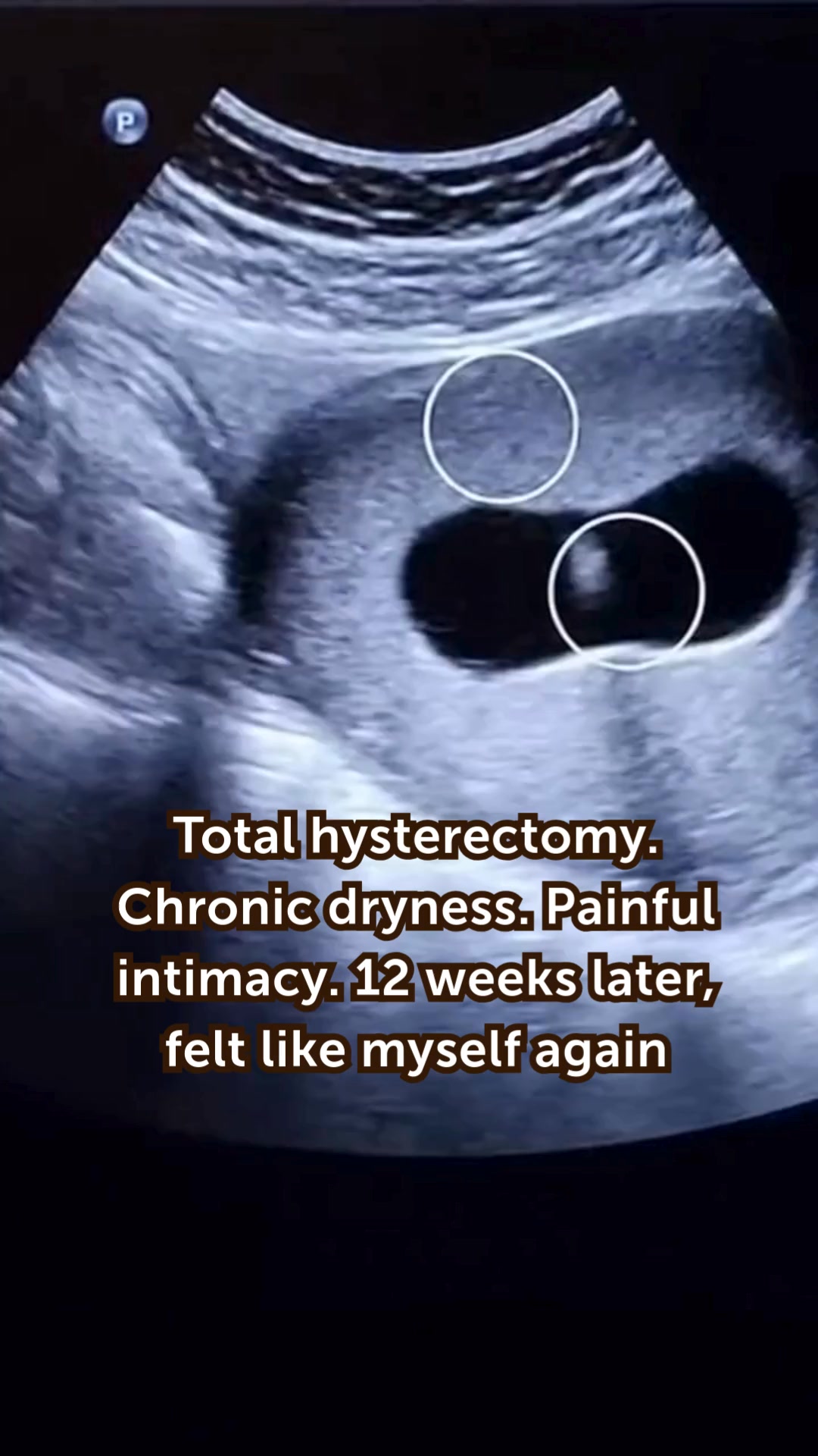 Linda Warren Facebook ad: Lost My Uterus. Then Nearly My Marriage
