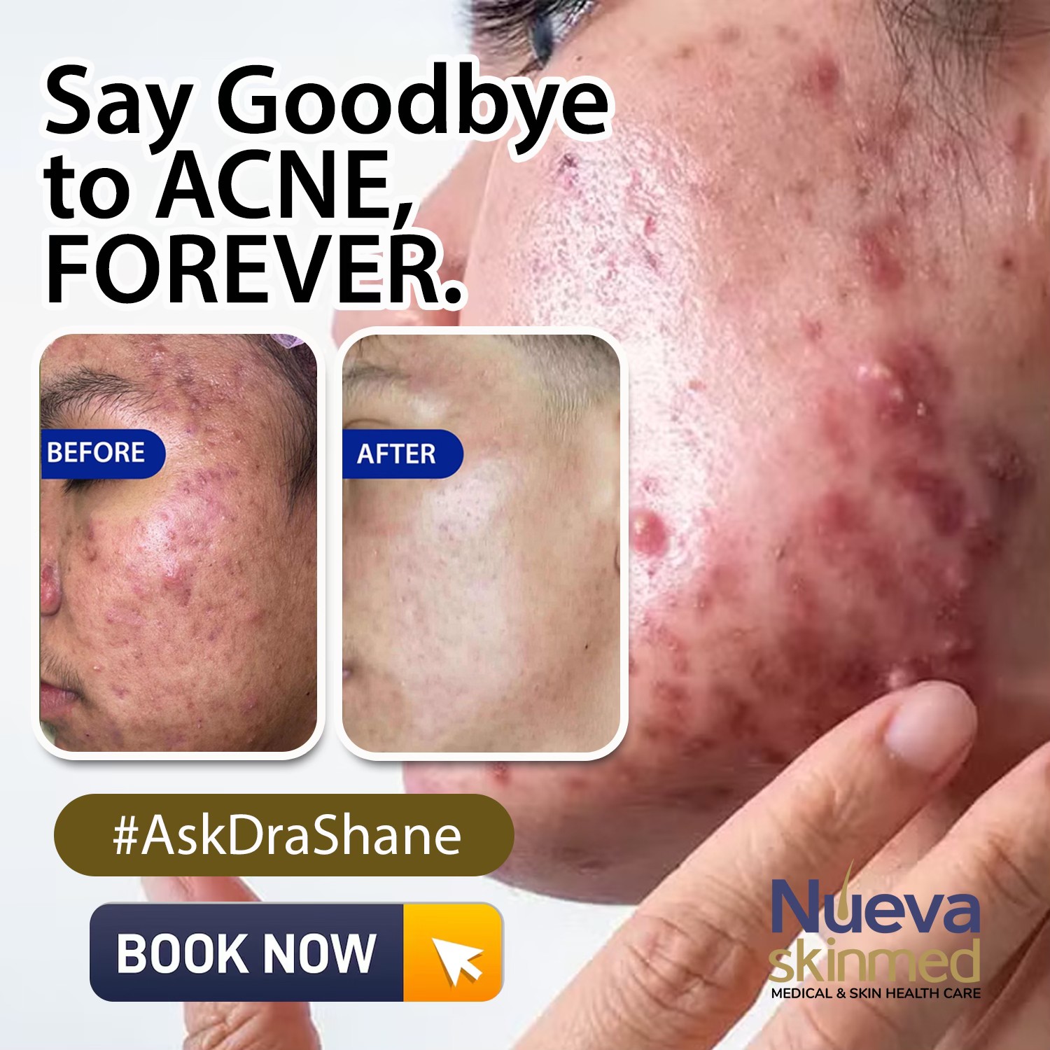 Nueva SkinMed Clinic Facebook ad: Say Goodbye to Acne, Forever with our Acne…