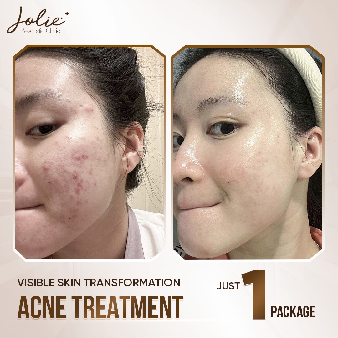 Jolie Skincare Spa Pampanga Facebook ad: ACNE TREATMENT, MEDICAL-GRADE SOLUTION FOR CLEAR SKIN