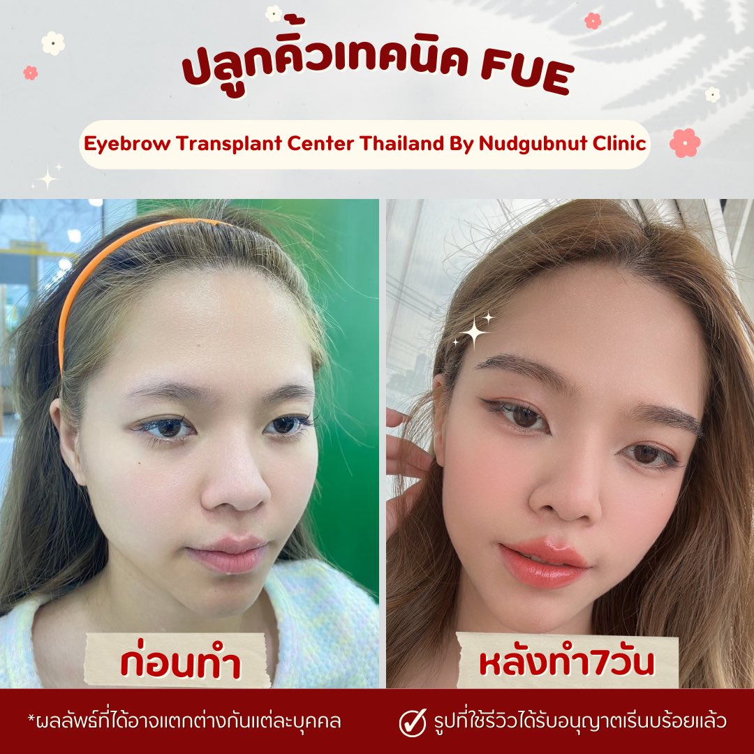 Eyebrow Transplant Thailand ปลูกคิ้ว นัดกับณัฐคลินิก Facebook ad: ปลูกติ้วโปรรีวิว29,999.-