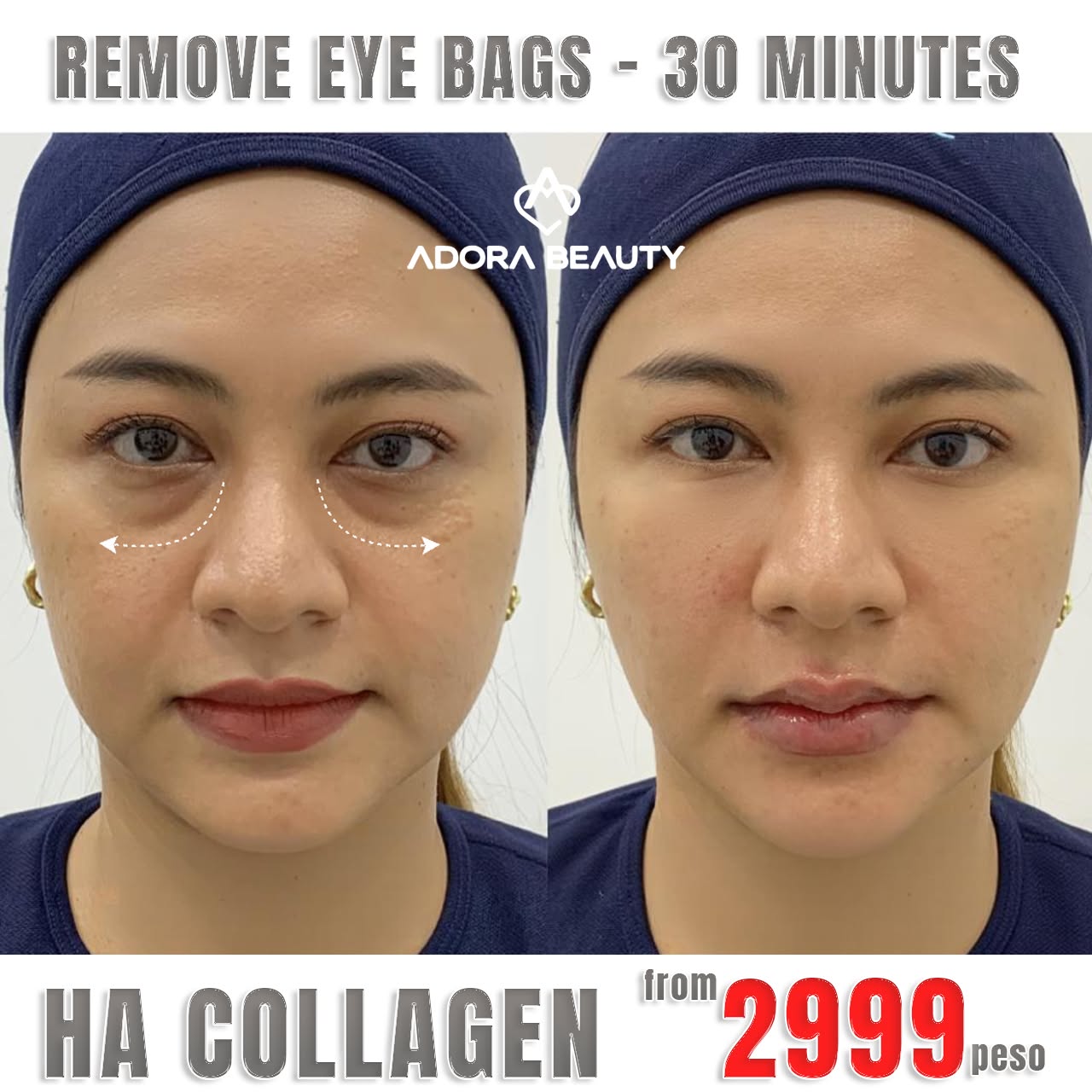 Adora Beauty Center - The Beauty Paradise No.1 in the Philippines Facebook ad: Get a free consultation now!