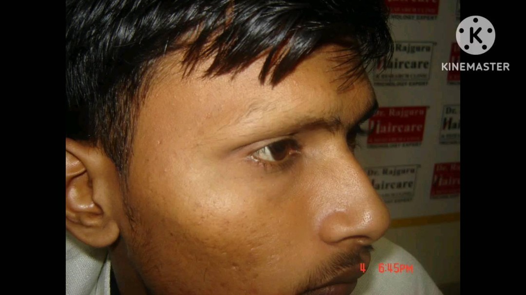 rajguruhaircareclinic Facebook ad: Eyebrow Hair Loss treatment