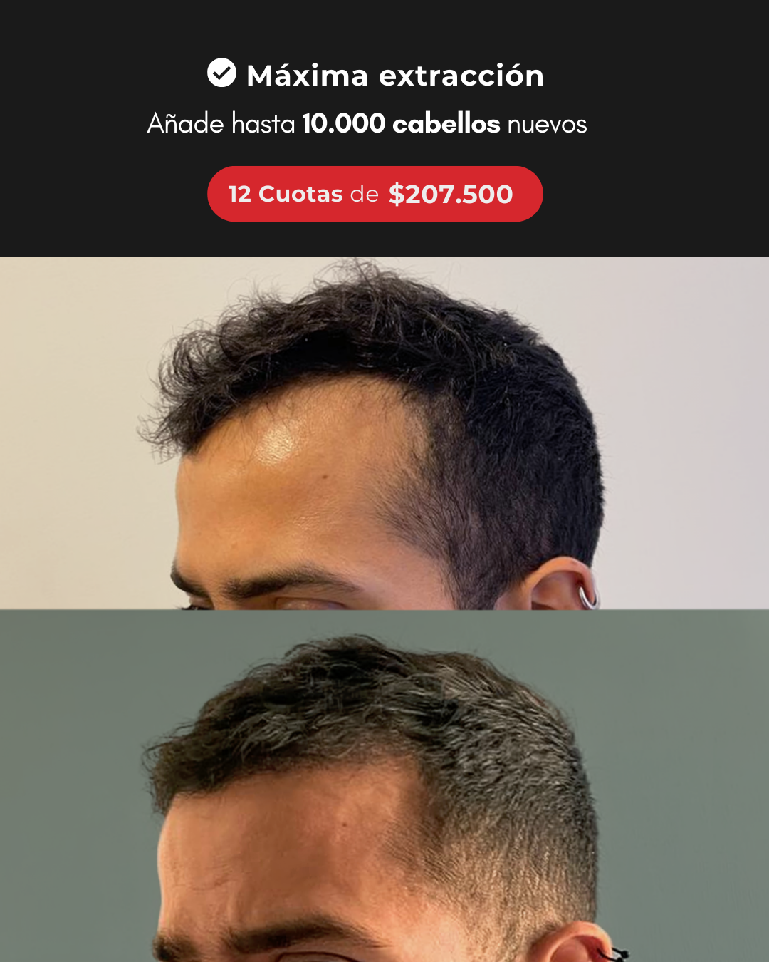 Rafael Odreman MD Facebook ad: Trasplante capilar de máxima extracción