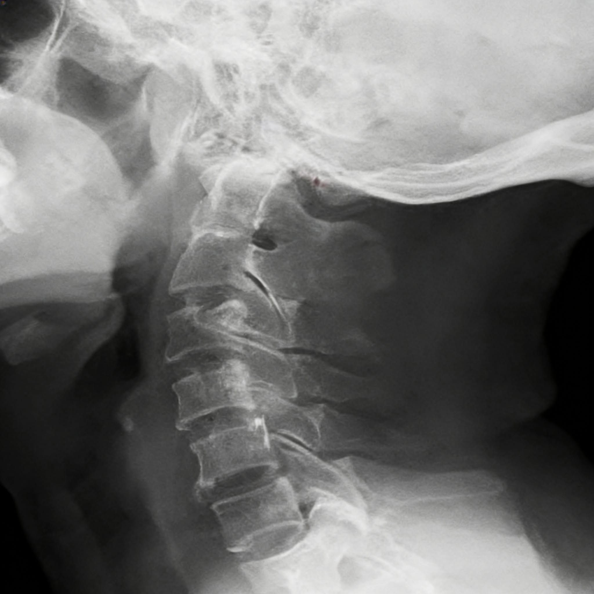 The Inner Ear Report Facebook ad: Read This If You Had Whiplash And Now Have Tinnitus And…
