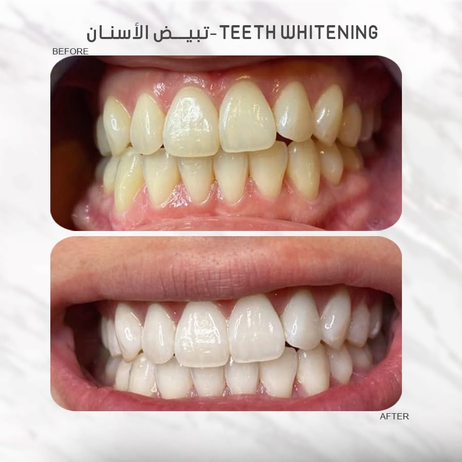 Bliss Medical Center مركز بليس الطبي Facebook ad: كوني مميزة بابتسامة بيضاء ومشرقة مع جلسة تبييض…