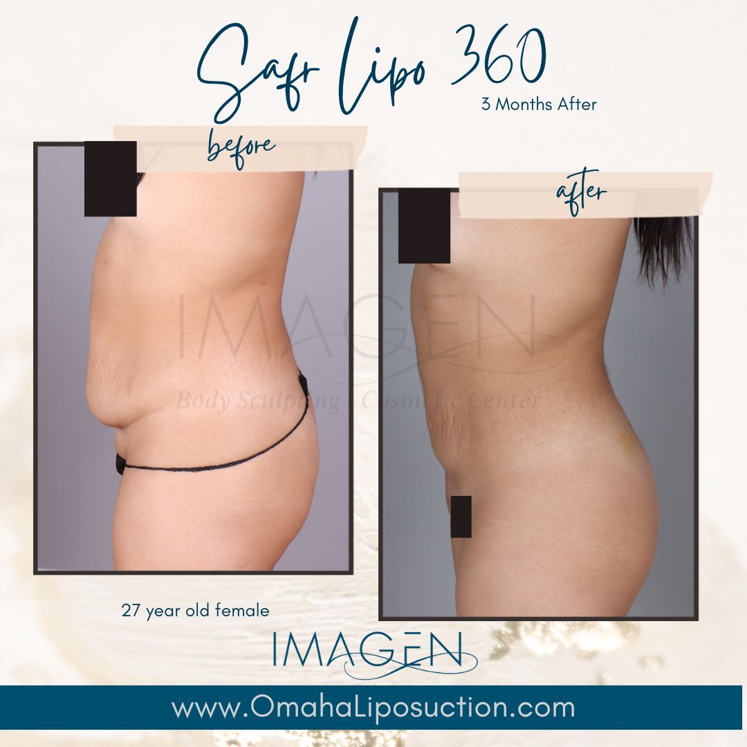 Imagen Body Sculpting & Cosmetic Center Facebook ad: Stubborn belly fat?