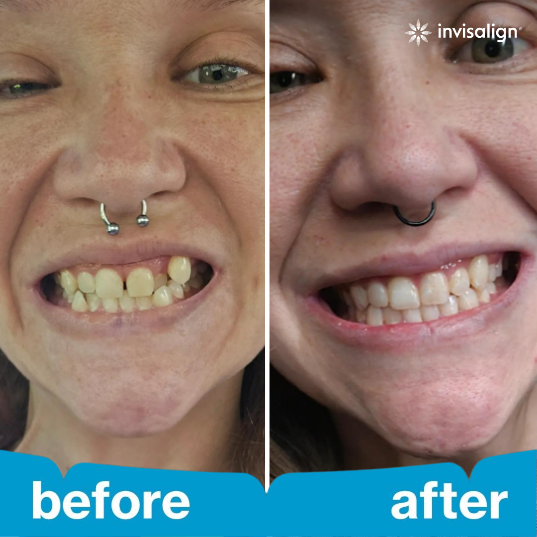Invisalign Facebook ad