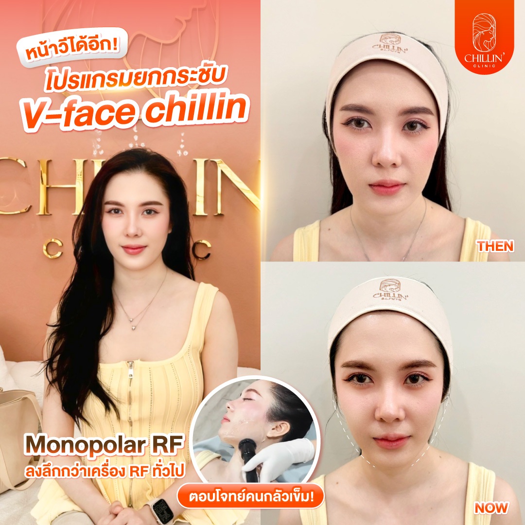 Chillin Clinic เชียงราย ที่ปรึกษาความงาม Facebook ad: หน้าวีได้อีก! นาทีนี้ใครอยากหน้าเรียว