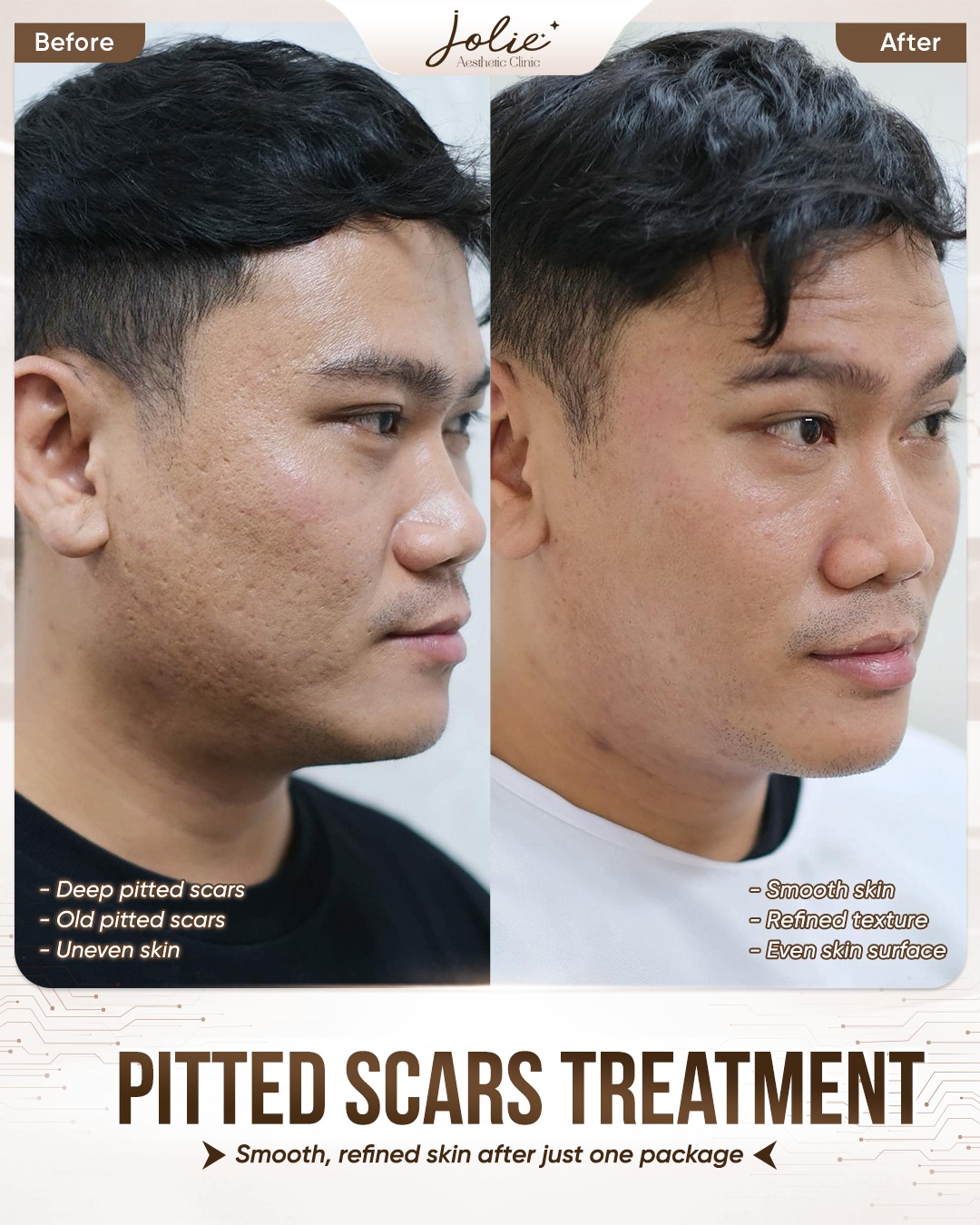 Jolie Ageless Beauty Johor Facebook ad: PITTED SCARS TREATMENT, VISIBLE SKIN SMOOTHING AFTER ONE…