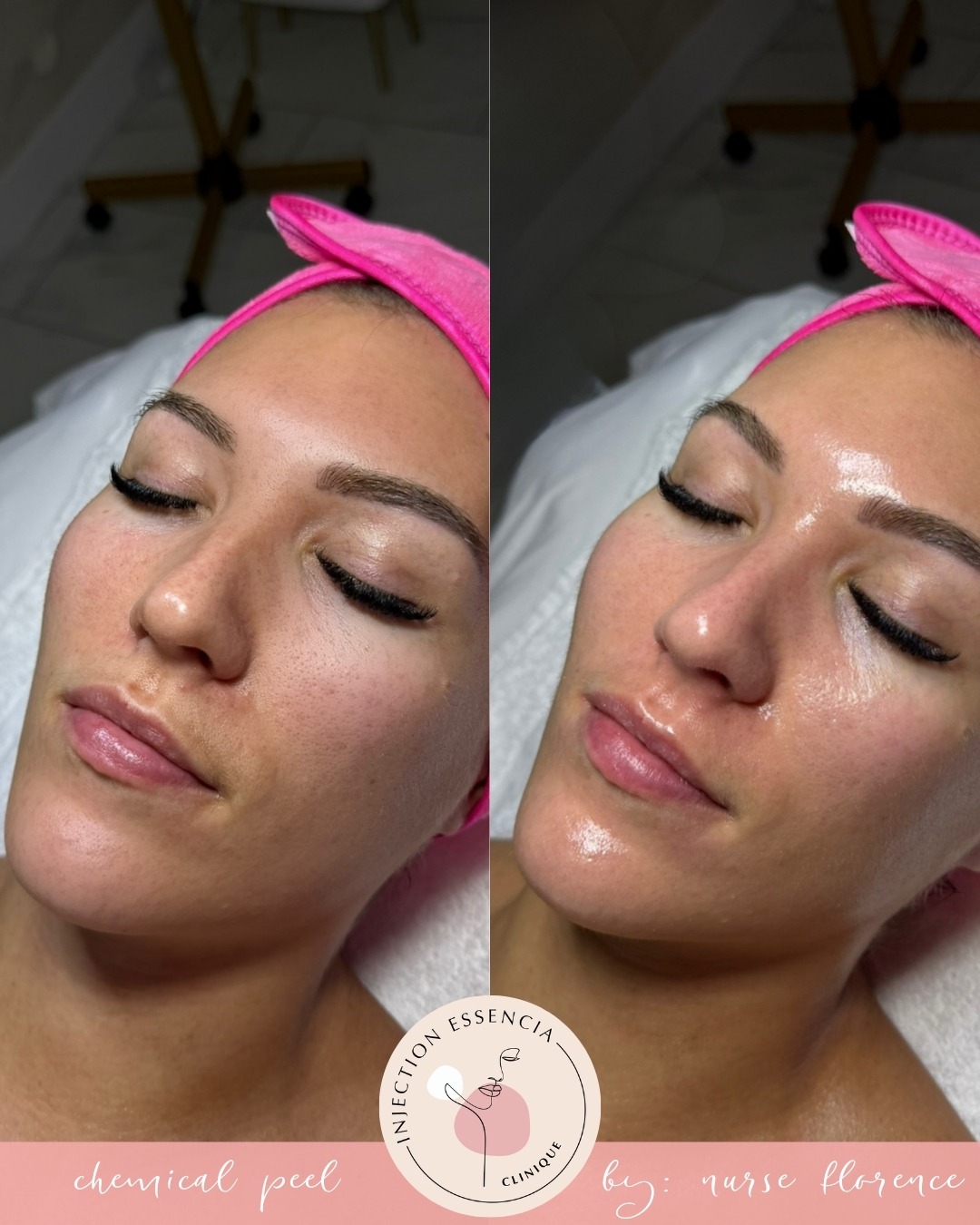 Clinique injection essencia Facebook ad