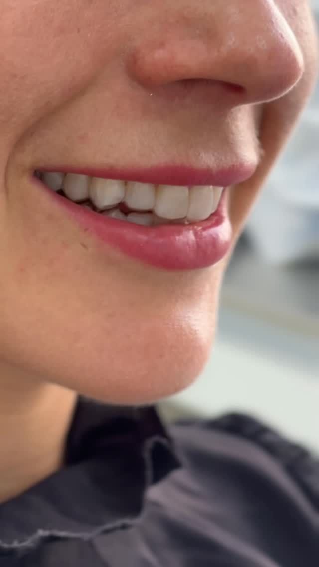 Muna Alineadores Facebook ad: Así de simple es colocarte tus alineadores dentales…
