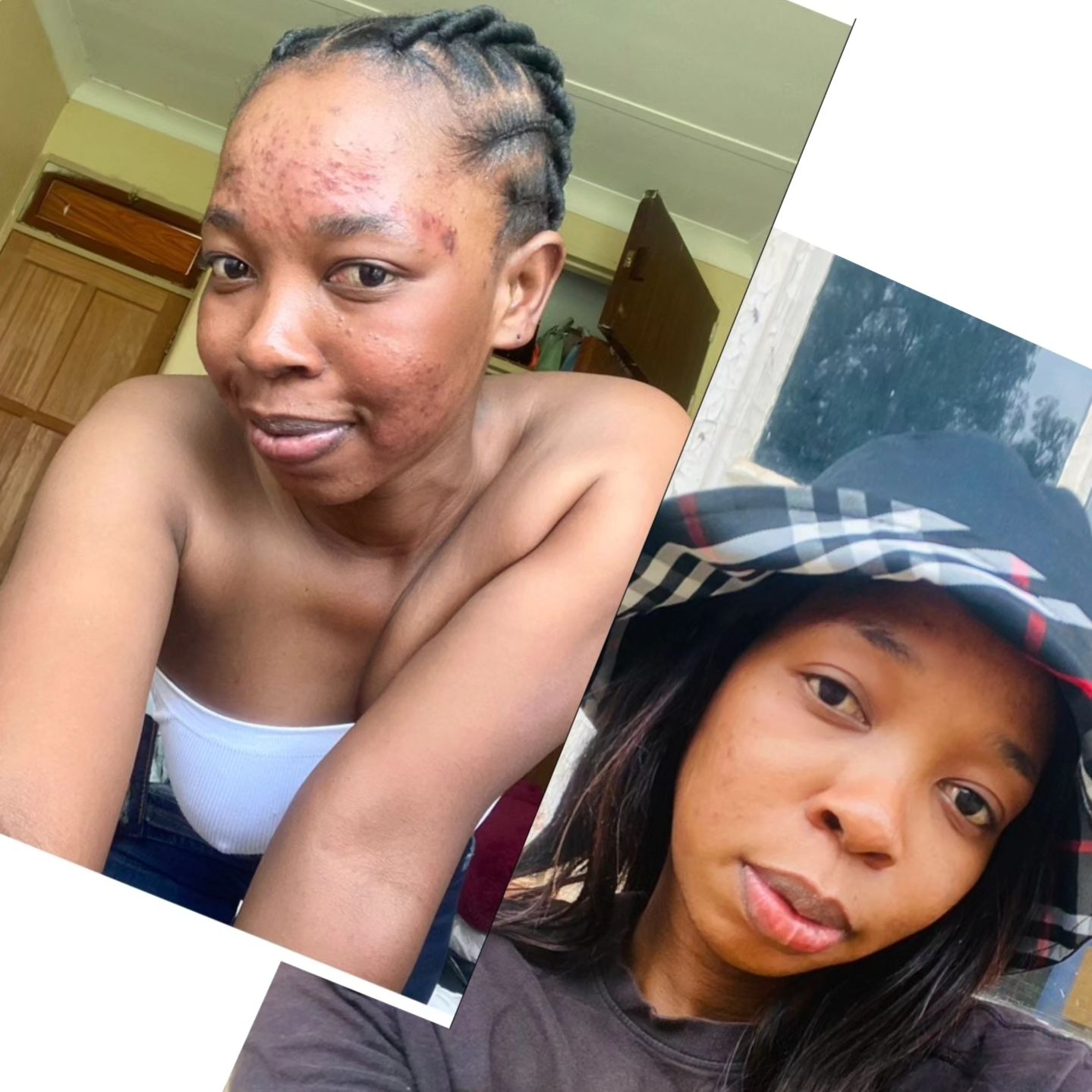 Karabo M Skin Products SA By MKM Pty Facebook ad: She use out Acne Combo R400