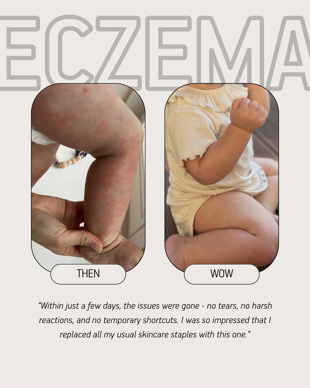 LUMI Facebook ad: When your baby’s skin is flaring, you’ll try…