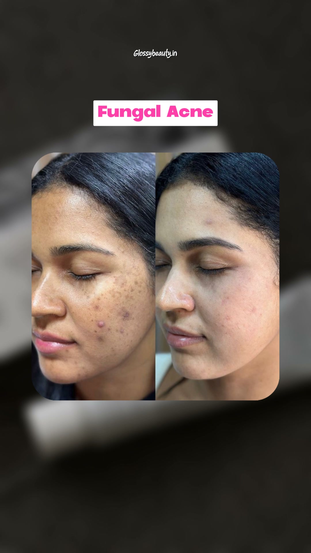The Glossy.Beauty Facebook ad: Clear Acne, Fade Dark Spots & Brighten Skin