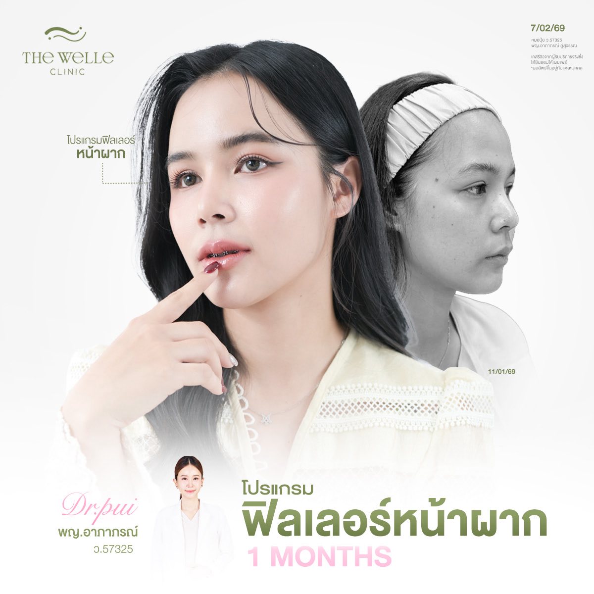 The Welle Clinic Facebook ad: โปรแกรมฟิลเลอร์หน้าผาก ช่วยเติมเต็มความละมุน ให้กับใบหน้า