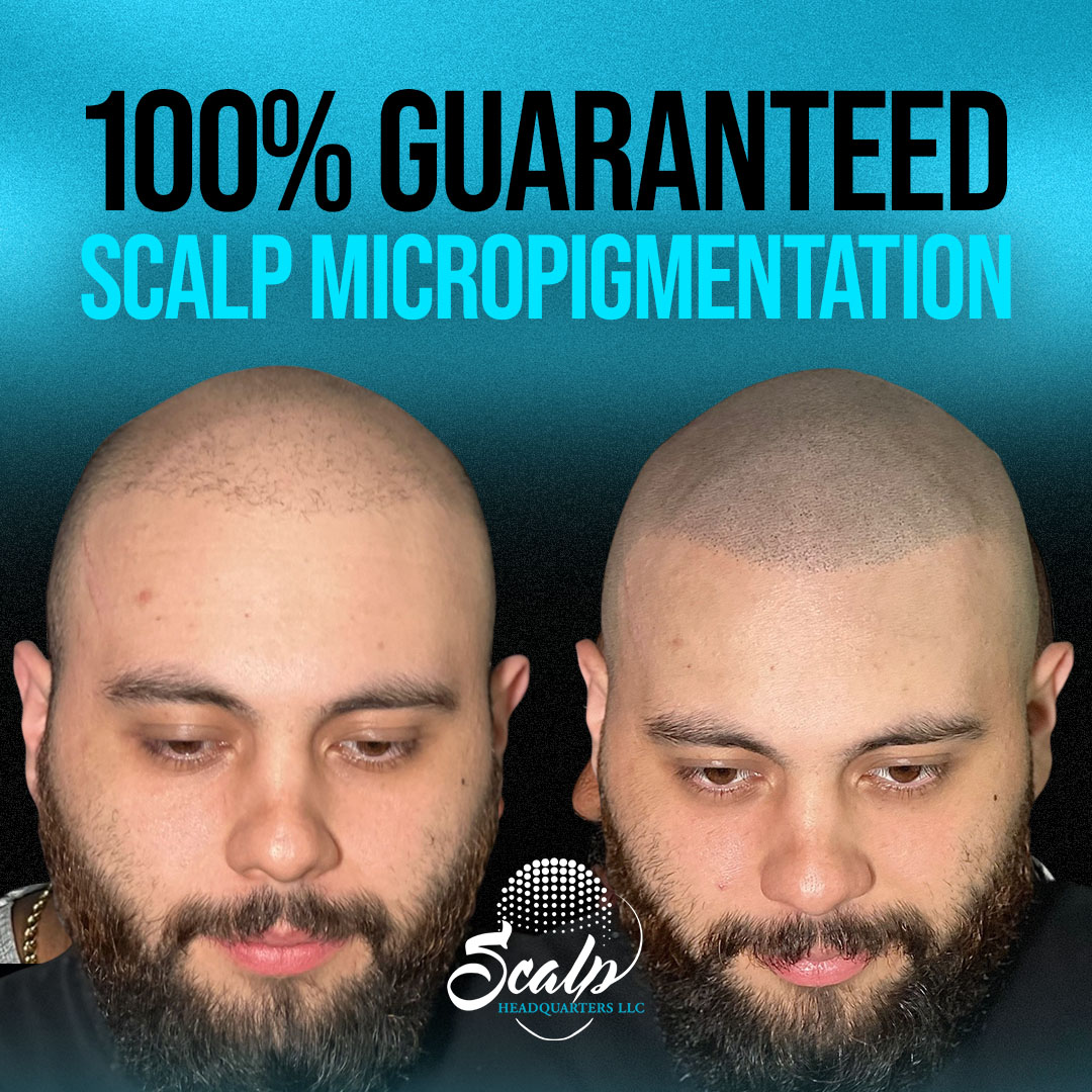 Scalp Headquarters Facebook ad: Missouri, Stop Hair Loss Without Surgery