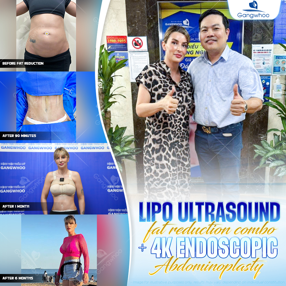 Gangwhoo Facebook ad: -50% Tummy Tuck