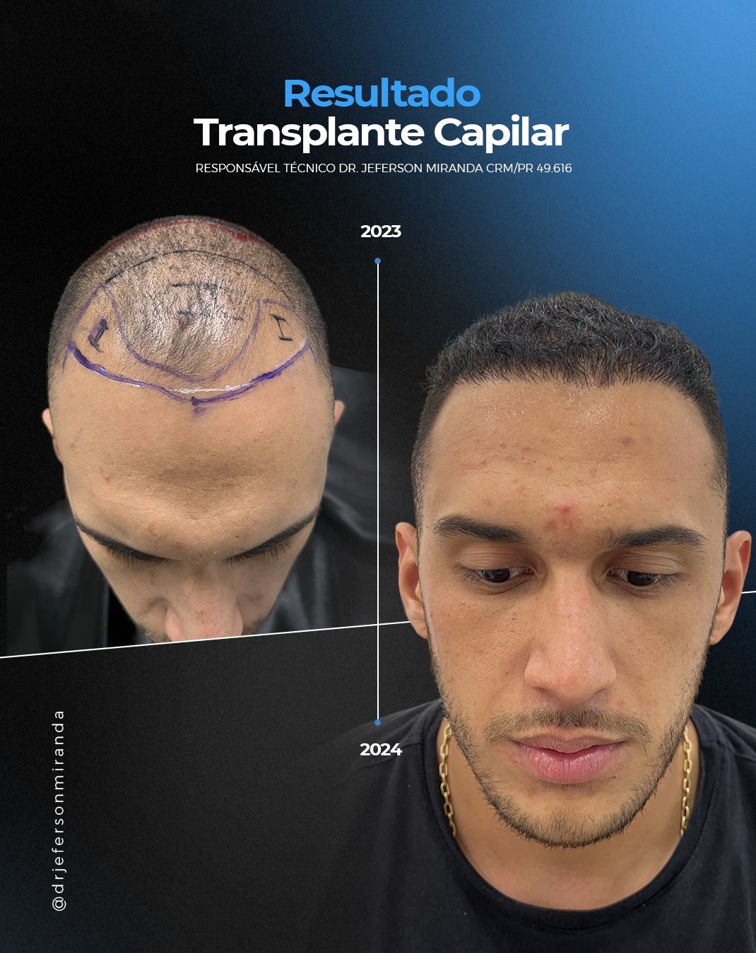 Dr. Jeferson Miranda Facebook ad: Antes: entradas profundas, linha frontal cada vez mais…