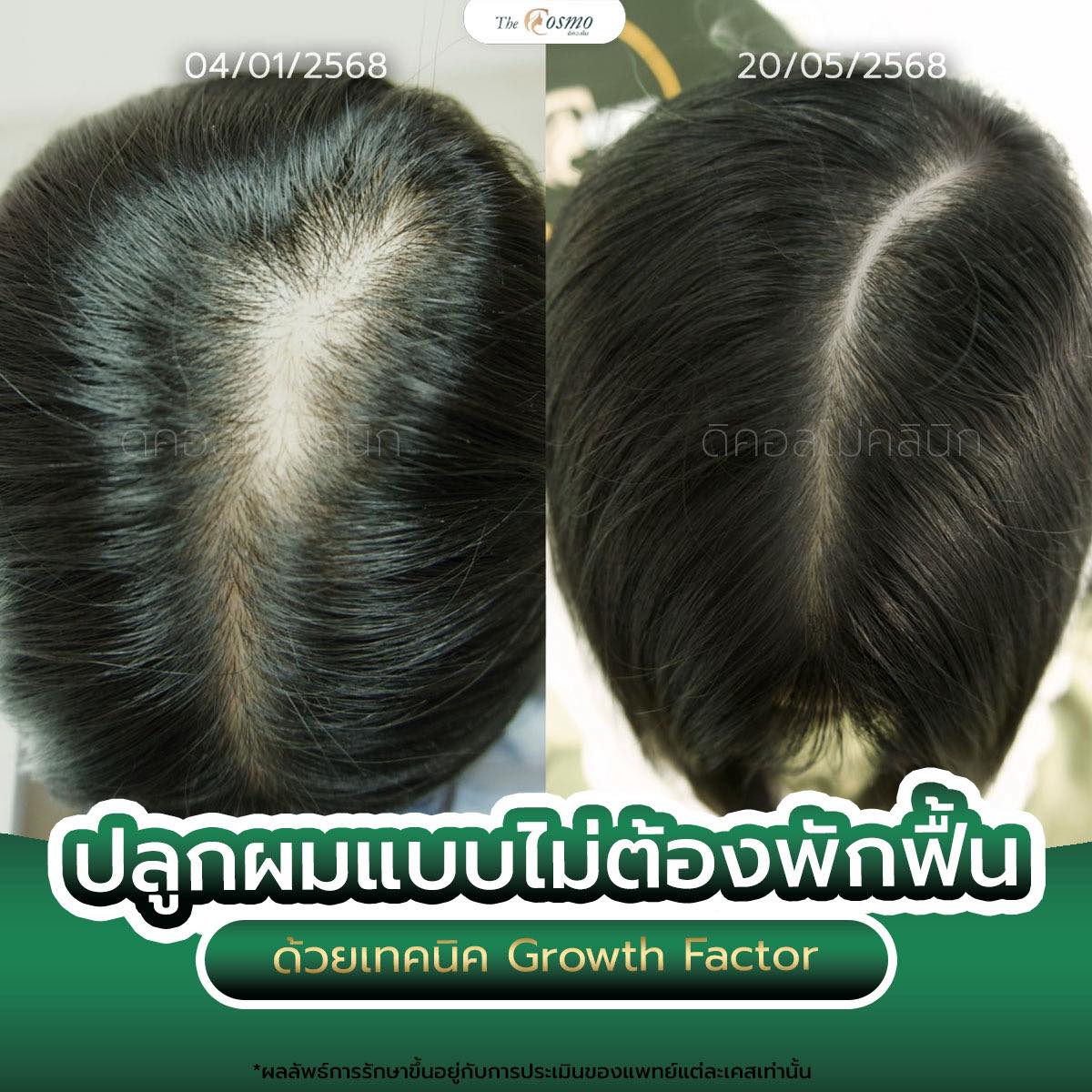 The Cosmo Clinic หาดใหญ่ Facebook ad: แบบไร้แผล ด้วยโปรแกรม PRP Growth Factor