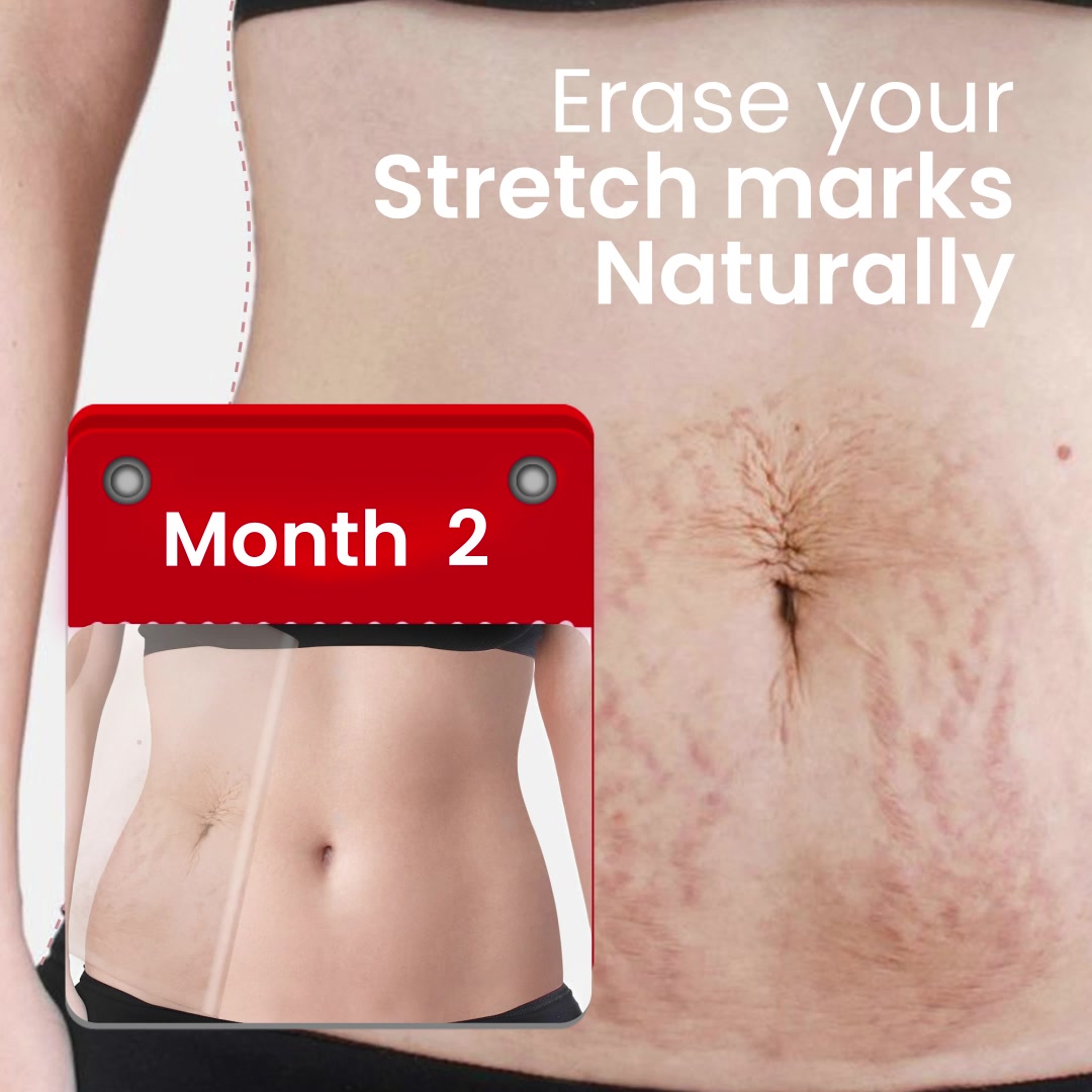 Healofy Facebook ad: Say bye to Stretchmarks with Pack of 2 creams