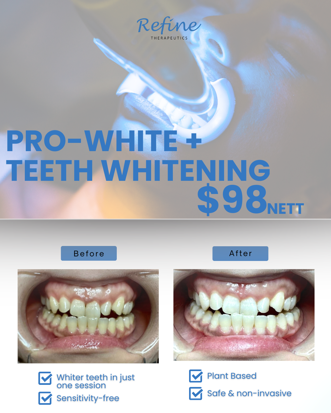 ๐๐๐๐ข๐ง๐ ๐๐ก๐๐ซ๐๐ฉ๐๐ฎ๐ญ๐ข๐๐ฌ Facebook ad: Brighter Smile in Just 1 Session, Only $98!