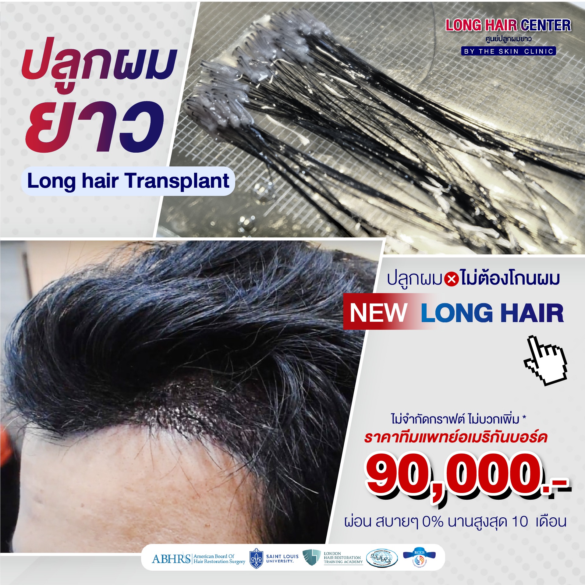 ปลูกผม Long Hair โดย หมอท็อป The skin clinic แพทย์อเมริกันบอร์ด Facebook ad