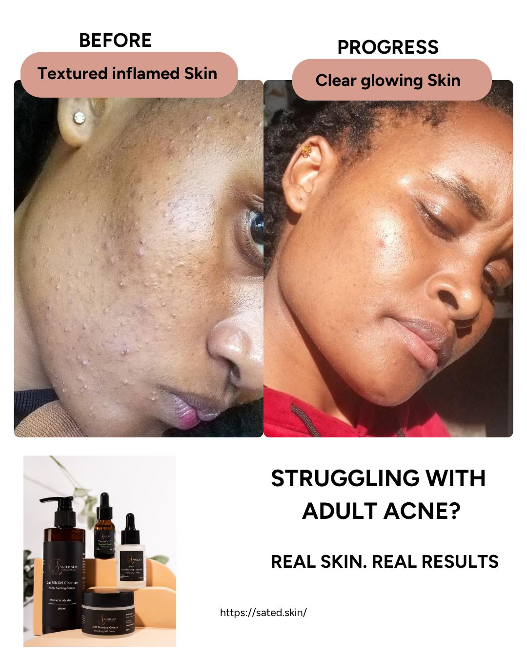 Sated Skin Facebook ad: Say goodbye to persistent breakouts and dark spots!