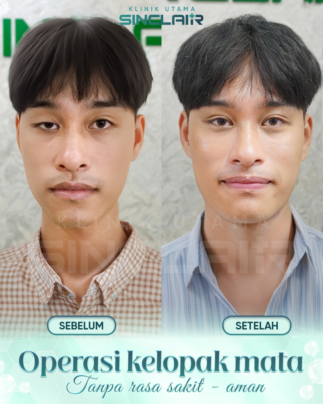 SinClair Beauty & Clinic - Eye Surgery Facebook ad: Pria ini memiliki kelainan bawaan pada otot mata…