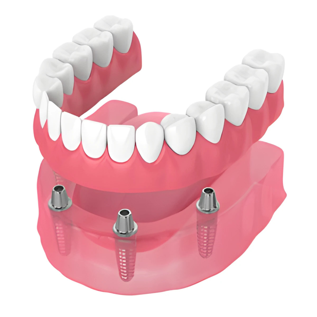 Lifetime Dental & Implants Center Facebook ad: Implant-Supported Dentures: $8,999 per arch
